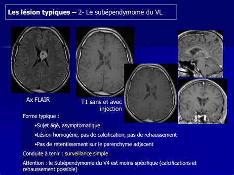 TUMEURS INTRAVENTRICULAIRES Ma bibliothèque en Imagerie Médicale