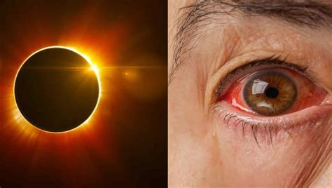 Esto Te PasarÁ Si Viste El Eclipse Sin Protección Ocular