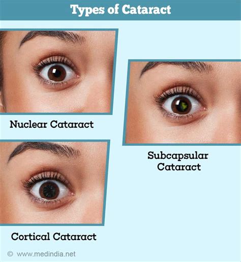 Cataract Causes Symptoms Diagnosis Treatment And Prevention