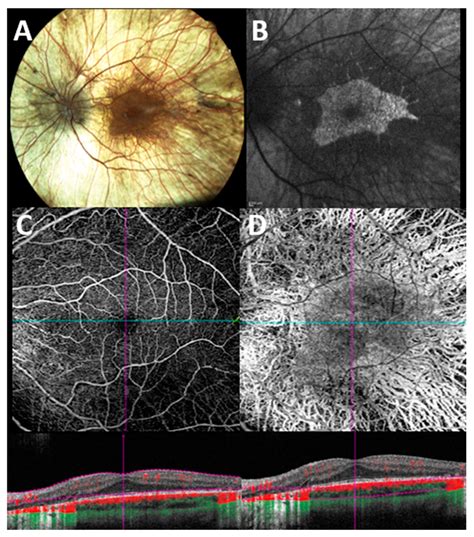 Multimodal Imaging Evaluation In A Patient With Genetically Confirmed