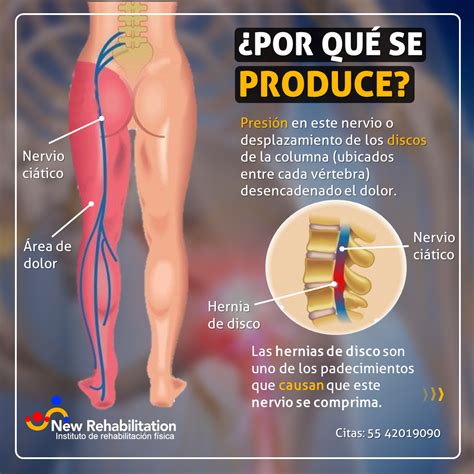 Por qué se da la ciática Sabías que existe una falsa ciática