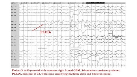 Generalised Periodic Epileptiform Discharges