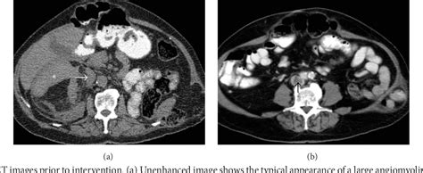 Figure From Combination Of Superselective Arterial Embolization And