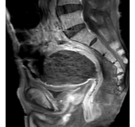 Irm Pelvienne Coupe Sagittale S Quence Pond R E En T Avec Injection