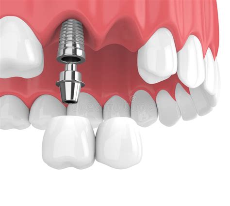 D Render Of Implants With Dental Cantilever Bridge In Upper Jaw Stock