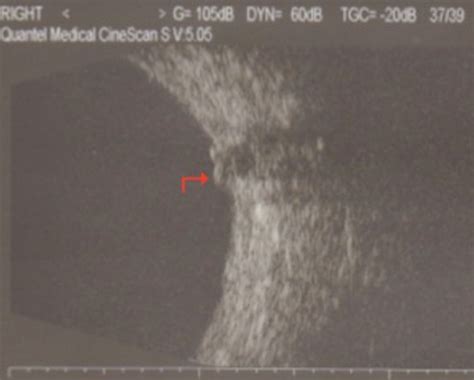 B-scan ultrasound of the right optic nerve, showing optic nerve head... | Download Scientific ...