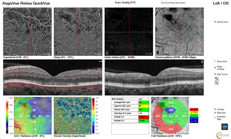 Angiographie 01 OCT OPHTALBI