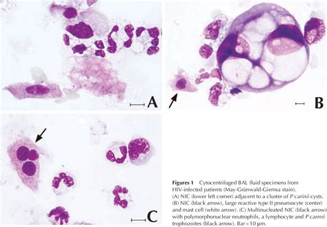 Figure 1 From Bronchoalveolar Lavage Fluid Cytology In Patients With Pneumocystis Carinii