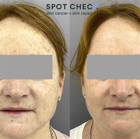 Sun Damaged Skin Spot Check Skin Cancer Aesthetics Melbourne Cbd