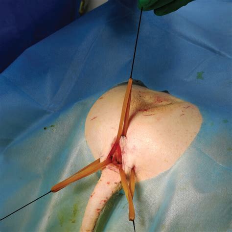 Porcine Anal Fistulae Model Creation Process Using Rubber Ligation