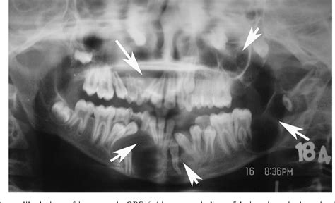 Figure 1 From Nevoid Basal Cell Carcinoma Syndrome In Indian Patients A Clinical And