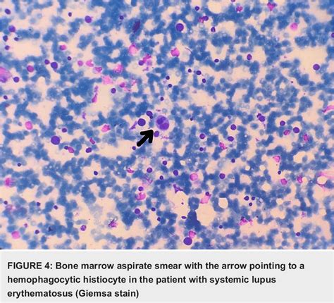 Table 1 From Secondary Hemophagocytic Lymphohistiocytosis A Series Of