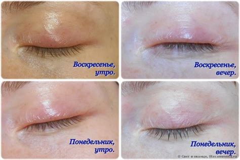 Ячмень на глазу: как лечить быстро дома и чем вылечить?