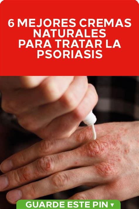 Cremas Naturales Para Tratar La Psoriasis En Este Art Culo Te