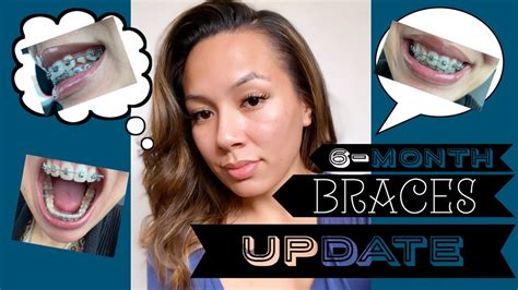 Braces Update 6 Months Youtube