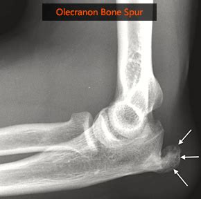 Olecranon Bursitis Xray