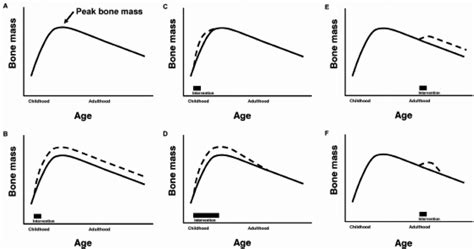 Conceptual Graphs Of Bone Mass As A Function Of Age ⁵² A Showed That