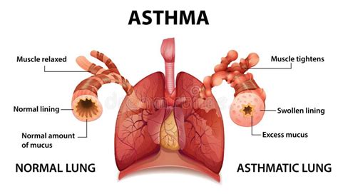 Human Anatomy Asthma Diagram Stock Vector Illustration Of Health