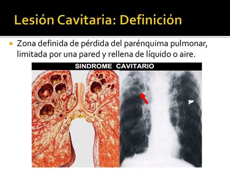 Lesiones Cavitarias Y Quísticas Del Pulmón