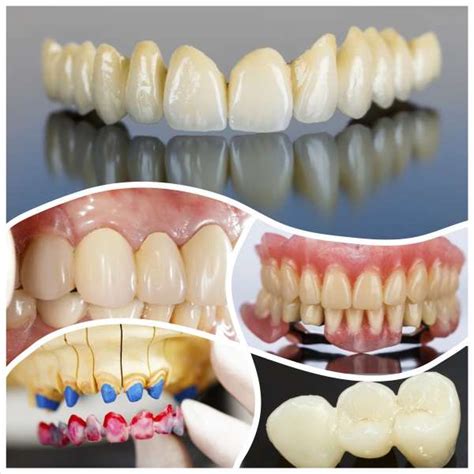 Crown And Bridges Work Dental Suites Pte Ltd