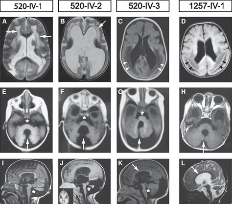 Pdf Mutations In Lamb Cause Cobblestone Brain Malformation Without