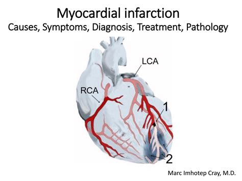 Myocardial infarction_ Causes, Symptoms, Diagnosis, Treatment, and ...