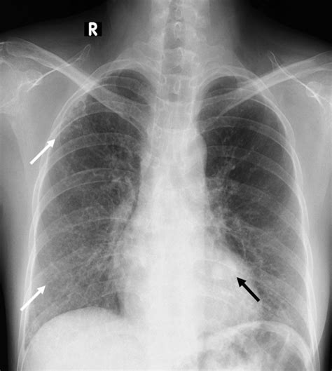 Chest Xray Posteroanterior View Revealed A Welldefined Homogeneous