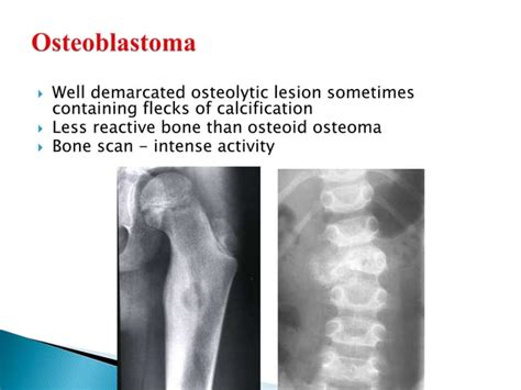 Radiology of Bone Tumours | PPT