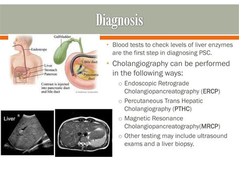 Ppt Primary Sclerosing Cholangitis Psc Powerpoint Presentation Free Download Id 1867571