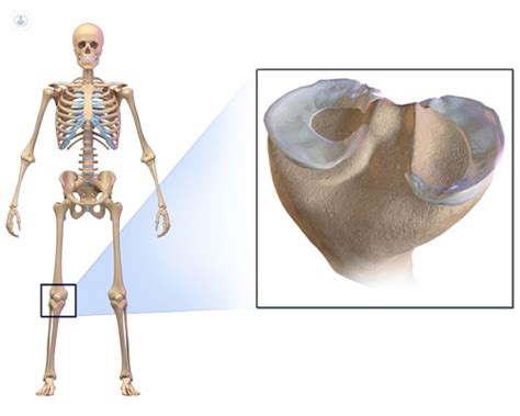 Meniscos qué es síntomas y tratamiento Top Doctors