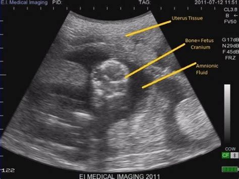 Ultrasound Basics; How to read an ultrasound image | Ultrasound ...