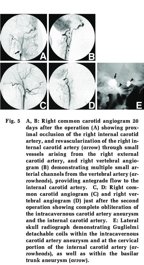 Magnetic Resonance Angiograms Day After Operation A Confirming