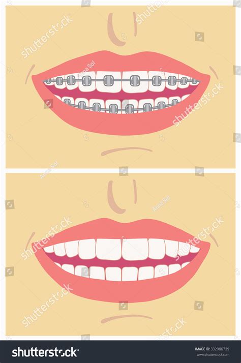 Smile Before After Wearing Braces Correctingvector Stock Vector (Royalty Free) 332986739 ...