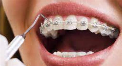 Maintaining Your Smile After Orthodontic Treatment Tips For Long Term