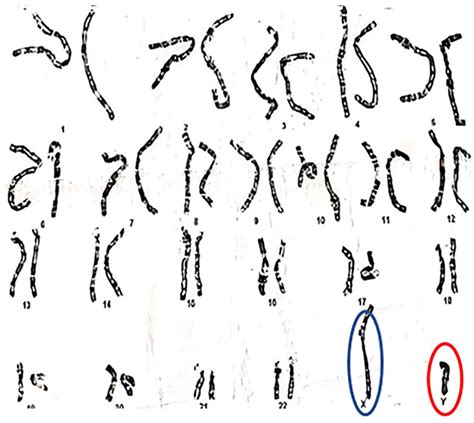 A Rare Case Of Swyer Syndrome From Pakistan In A Young Girl With