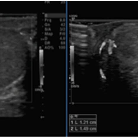 Scrotal Ultrasound Showed A Rounded Heterogenous Mass At The Tail Of