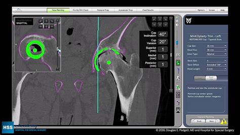 Total Hip Arthroplasty Posterior Approach With Robotic Assistance Part