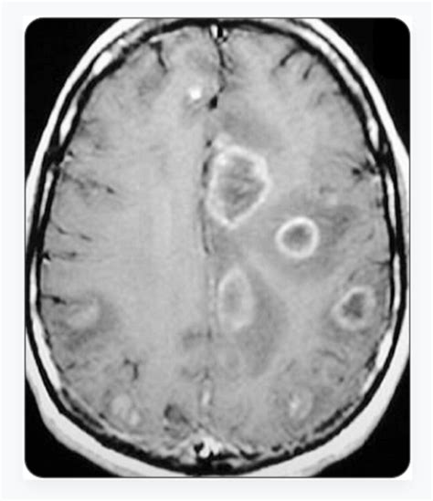 EmDOCs Net Emergency Medicine EducationEM 3AM CNS Toxoplasmosis In