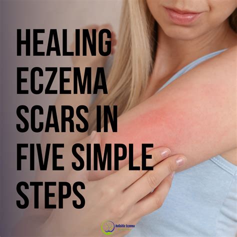 Healing Eczema Scars In 5 Simple Steps Diy Holistic Solutions