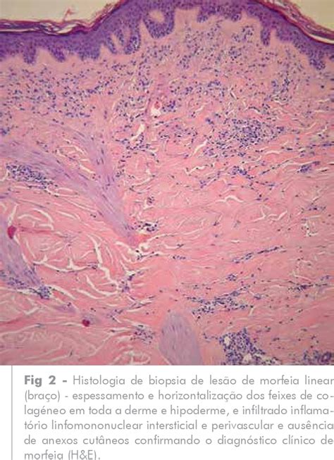 Figure From Morfeia Linear E L Quen Escleroso Genital Uma