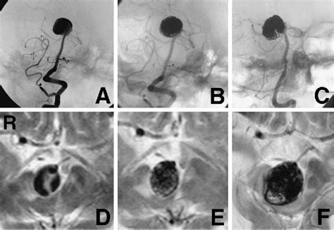 Figure 1 From Endoscopic Third Ventriculostomy For Obstructive Hydrocephalus Caused By A Large