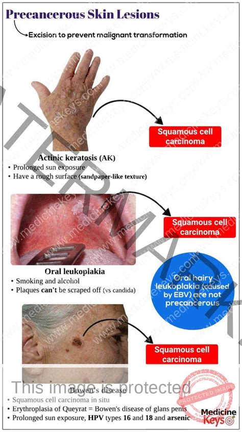 Precancerous Skin Lesions Medicine Keys For Mrcps