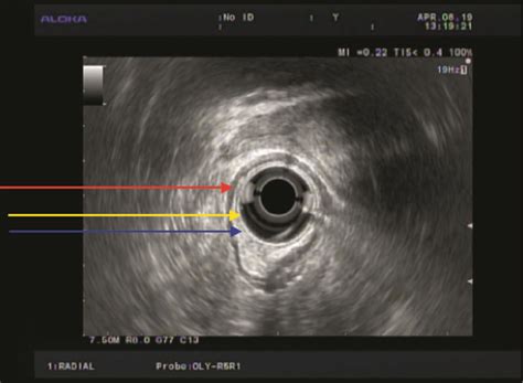 Rectal Endoscopic Ultrasound Eus Showing A Localized Hypoechoic