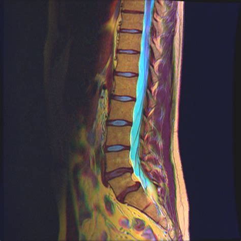 Nevit's blog: Color MRI of the vertebral column