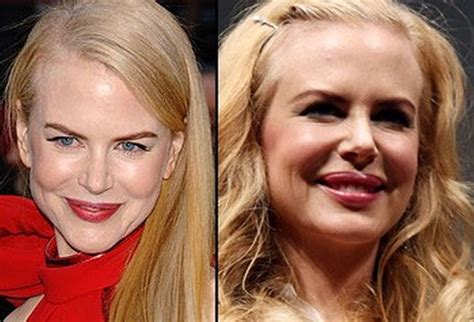Nicole Kidman Plastic Surgery - Rumors or Facts?