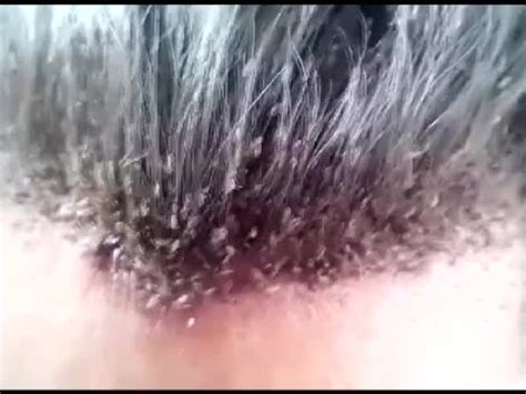 VIDEO: Migliaia di pidocchi sulla testa di un uomo - il Giornale