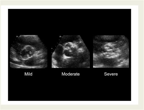 Pdf Association Of Mitral Annular Calcification And Aortic Valve