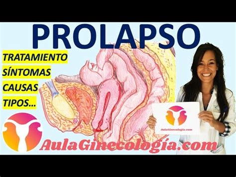 Prolapso De Rganos P Lvcos S Ntomas Tipos Exploraci N Tratamiento