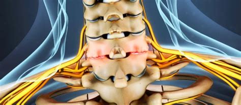 Sintomi Di Artrosi Cervicale Scopri Quali Sono E Come Alleviarli