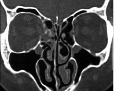 Orbital Fracture Imaging Practice Essentials Radiography Computed